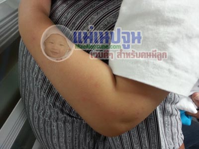 ไวรัสบางชนิดที่ไม่เป็นอันตรายอาจทำให้เกิดโรค celiac ได้ reovirus ในระด