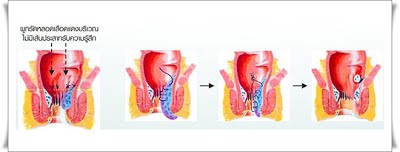 การรักษาโรคริดสีดวงทวาร